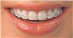Ai dintii strambi? Clinica City Dent va propune cateva aparate dentare de ultimă generaţie.