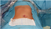O nouă abordare pentru tumorile hepatice: chirurgia LESS transombilicală, fără cicatrici. Cronica unei noi premiere chirurgicale la Spitalul Sf.Constantin din Braşov